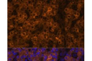 Immunofluorescence analysis of Human liver cancer using TTR Polyclonal Antibody at dilution of 1:100 (40x lens).