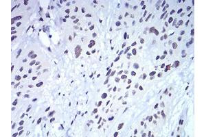 Immunohistochemical analysis of paraffin-embedded esophageal cancer tissues using CBX5 mouse mAb with DAB staining. (CBX5 anticorps  (AA 1-191))