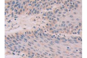 DAB staining on IHC-P; Samples: Human Stomach cancer Tissue (IL-33 anticorps  (AA 1-270))
