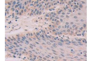 DAB staining on IHC-P; Samples: Human Stomach cancer Tissue