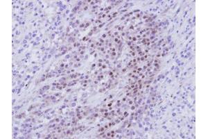 IHC-P Image Immunohistochemical analysis of paraffin-embedded SAS Xenograft , using RBMY1A1, antibody at 1:100 dilution. (RBMY1A1 anticorps)