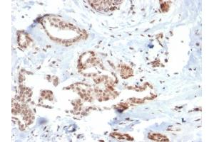 Formalin-fixed, paraffin-embedded human Breast Carcinoma stained with SOX4 Mouse Monoclonal Antibody (SOX4/2540). (SOX4 anticorps)