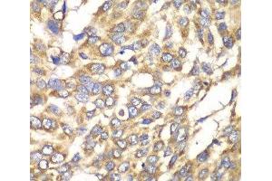 Immunohistochemistry of paraffin-embedded Human esophageal cancer using VTI1B Polyclonal Antibody at dilution of 1:100 (40x lens). (VTI1B anticorps)