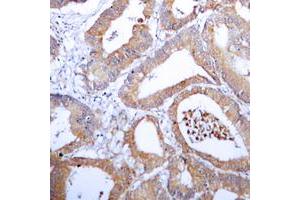 Immunohistochemical analysis of Aldose Reductase staining in human colon cancer formalin fixed paraffin embedded tissue section. (AKR1B1 anticorps  (C-Term))