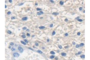 Detection of KRT33A in Human Glioma Tissue using Polyclonal Antibody to Keratin 33A (KRT33A)