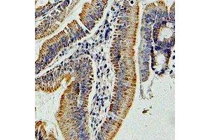 Immunohistochemical analysis of GNAI3 staining in human colon cancer formalin fixed paraffin embedded tissue section. (GNAI3 anticorps)