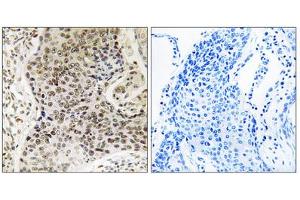 Immunohistochemistry analysis of paraffin-embedded human lung carcinoma tissue, using TSEN54 antibody. (TSEN54 anticorps  (Internal Region))