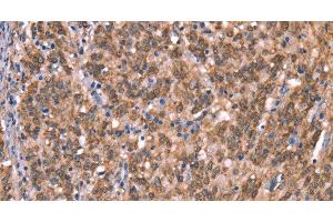 Immunohistochemistry of paraffin-embedded Human gasrtic cancer tissue using GCSAM Polyclonal Antibody at dilution 1:40