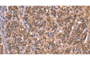 Immunohistochemistry of paraffin-embedded Human gasrtic cancer tissue using GCSAM Polyclonal Antibody at dilution 1:40 (GCET2 anticorps)