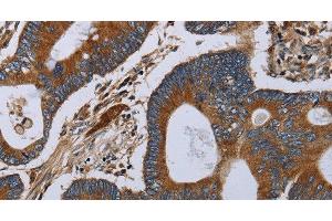 Immunohistochemistry of paraffin-embedded Human colon cancer tissue using MT-ND6 Polyclonal Antibody at dilution 1:40 (MT-ND6 anticorps)