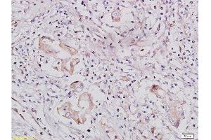 Formalin-fixed and paraffin-embedded human lung carcinoma tissue labeled with Rabbit Anti-IGF1R/CD221 Polyclonal Antibody, Unconjugated  at 1:300 followed by conjugation to the secondary antibody and DAB staining (IGF1R anticorps  (AA 251-350))