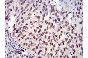 Immunohistochemical analysis of paraffin-embedded ovarian cancer tissues using JAK2 mouse mAb with DAB staining.