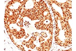 Formalin-fixed, paraffin-embedded human Breast Carcinoma stained with ER-beta1 Mouse Monoclonal Antibody (ERb455). (ESR2 anticorps  (C-Term))