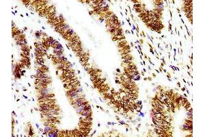 IHC image of ABIN7127295 diluted at 1:100 and staining in paraffin-embedded human colon cancer performed on a Leica BondTM system.