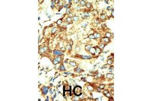 Formalin-fixed and paraffin-embedded human hepatocellular carcinoma tissue reacted with the primary antibody, which was peroxidase-conjugated to the secondary antibody, followed by DAB staining. (Dnmt2 anticorps  (AA 353-383))