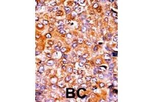 Formalin-fixed and paraffin-embedded human cancer tissue reacted with PKMYT1 (phospho T495) polyclonal antibody  which was peroxidase-conjugated to the secondary antibody followed by AEC staining. (PKMYT1 anticorps  (pThr495))