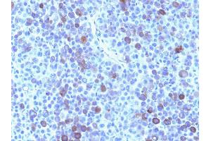 Formalin-fixed, paraffin-embedded human Melanoma stained with Glypican-3 Mouse Monoclonal Antibody (GPC3/863) (Glypican 3 anticorps)