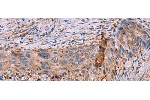 Immunohistochemistry of paraffin-embedded Human cervical cancer tissue using KBTBD11 Polyclonal Antibody at dilution of 1:35(x200) (KBTBD11 anticorps)