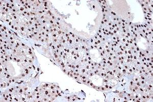 Immunohistochemistry of paraffin-embedded human liver cancer using macroH2A. (H2AFY anticorps)
