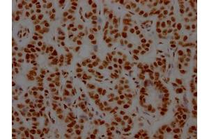 IHC image of ABIN7127643 diluted at 1:100 and staining in paraffin-embedded human breast cancer performed on a Leica BondTM system. (Recombinant NONO anticorps)