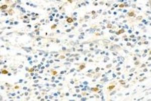 Immunohistochemistry analysis of paraffin-embedded human appendix using,PARP1 (ABIN7075114) at dilution of 1: 750 (PARP1 anticorps  (cleaved))
