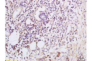 Formalin-fixed and paraffin embedded Human esophageal carcinoma labeled with Anti-CXCL5 Polyclonal Antibody, Unconjugated (ABIN741900) at 1:200, followed by conjugation to the secondary antibody and DAB staining (CXCL5 anticorps  (AA 51-132))