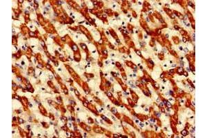 Immunohistochemistry of paraffin-embedded human liver cancer using ABIN7149659 at dilution of 1:100 (ECH1 anticorps  (AA 36-135))