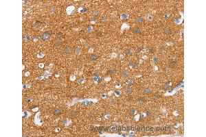 Immunohistochemistry of Human thyroid cancer using SNCA Polyclonal Antibody at dilution of 1:30 (SNCA anticorps)
