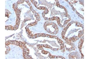Formalin-fixed, paraffin-embedded human Prostate Carcinoma stained with Cytokeratin 15 Mouse Monoclonal Antibody (KRT15/2957)