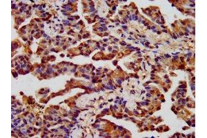 IHC image of ABIN7161356 diluted at 1:400 and staining in paraffin-embedded human lung cancer performed on a Leica BondTM system. (CHRNB3 anticorps  (AA 67-218))