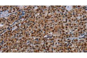 Immunohistochemistry of paraffin-embedded Human thyroid cancer tissue using DCAF6 Polyclonal Antibody at dilution 1:30 (DCAF6 anticorps)