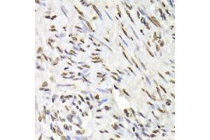 Immunohistochemistry of paraffin-embedded human adenomyosis using HNRNPD Antibody (ABIN5970929) at dilution of 1/100 (40x lens). (HNRNPD/AUF1 anticorps)