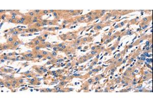 Immunohistochemistry of paraffin-embedded Human liver cancer using RAB18 Polyclonal Antibody at dilution of 1:300