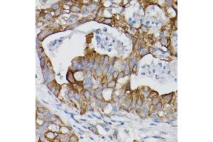 Immunohistochemistry of paraffin-embedded human lung cancer using IL18R1/IL-18 R alpha Rabbit pAb (ABIN3023690, ABIN3023691, ABIN3023692 and ABIN6219764) at dilution of 1:150 (40x lens). (IL18R1 anticorps  (AA 19-320))