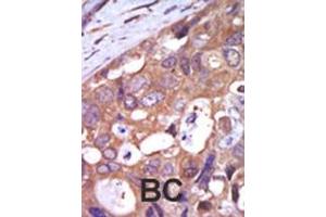 Formalin-fixed and paraffin-embedded human cancer tissue reacted with the primary antibody, which was peroxidase-conjugated to the secondary antibody, followed by AEC staining.