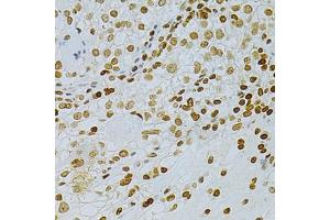 Immunohistochemistry of paraffin-embedded human cancer using DKC1 Antibody (ABIN5970956) at dilution of 1/200 (40x lens). (DKC1 anticorps)