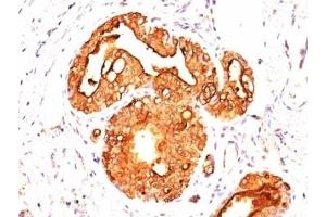 Formalin-fixed, paraffin-embedded human breast carcinoma stained with EMA antibody (MUC1/845). (MUC1 anticorps)