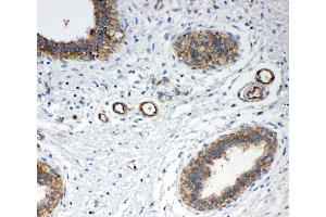 Anti-Annexin IV antibody,  IHC(P) IHC(P): Human Mammary Cancer Tissue