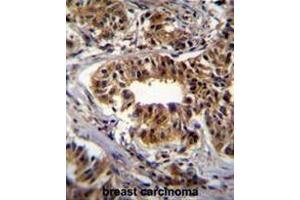 CAD Antibody (Center) immunohistochemistry analysis in formalin fixed and paraffin embedded human breast carcinoma followed by peroxidase conjugation of the secondary antibody and DAB staining. (CAD anticorps  (Middle Region))