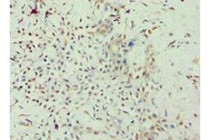 Immunohistochemistry of paraffin-embedded human breast cancer using ABIN7167947 at dilution of 1:100