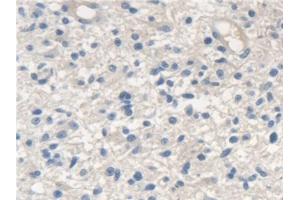 Detection of SCARA5 in Human Glioma Tissue using Polyclonal Antibody to Scavenger Receptor Class A Member 5 (SCARA5) (SCARA5 anticorps  (AA 118-495))
