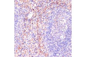 Immunohistochemistry of paraffin-embedded human colon carcinoma using Rap1A antibody (ABIN3021199, ABIN3021200, ABIN3021201 and ABIN6214062) at dilution of 1:100 (40x lens).