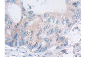 Detection of PAP in Human Colorectal cancer Tissue using Polyclonal Antibody to Prostatic Acid Phosphatase (PAP) (ACPP anticorps  (AA 217-386))