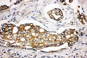 Anti-SPTLC1 antibody, IHC(P) IHC(P): Human Mammary Cancer Tissue (SPTLC1 anticorps  (Middle Region))