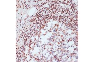 Immunohistochemistry of paraffin-embedded human colon carcinoma using Phospho-CREB1-S133 Rabbit pAb (ABIN3023522, ABIN3023523, ABIN3023524 and ABIN6225375) at dilution of 1:200 (40x lens). (CREB1 anticorps  (pSer133))