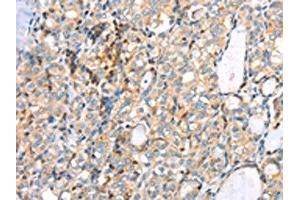 The image on the left is immunohistochemistry of paraffin-embedded Human thyroid cancer tissue using ABIN7191349(MAGEB2 Antibody) at dilution 1/40, on the right is treated with synthetic peptide. (MAGEB2 anticorps)