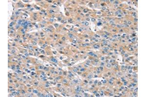 The image on the left is immunohistochemistry of paraffin-embedded Human liver cancer tissue using ABIN7192149(RASA3 Antibody) at dilution 1/30, on the right is treated with synthetic peptide. (RASA3 anticorps)