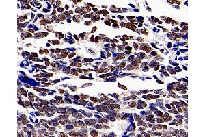 Immunohistochemistry analysis of paraffin-embedded human lung cancer using HDAC1 Polyclonal Antibody at dilution of 1:300. (HDAC1 anticorps)