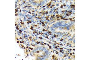 Immunohistochemistry of paraffin-embedded human colon carcinoma using T Rabbit mAb (ABIN7270916) at dilution of 1:100 (40x lens). (TACC3 anticorps)