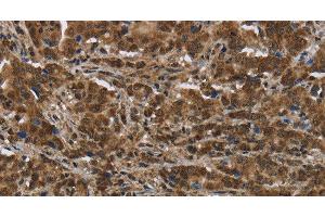 Immunohistochemistry of paraffin-embedded Human liver cancer tissue using PIP Polyclonal Antibody at dilution 1:50 (PIP anticorps)